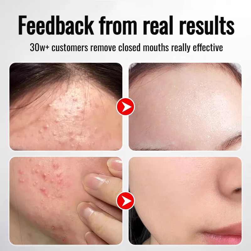 Herbal Exfoliating Gel - Skin Moisturizing Exfoliating Gentle Cleansing Gel Deep Brightening Gel